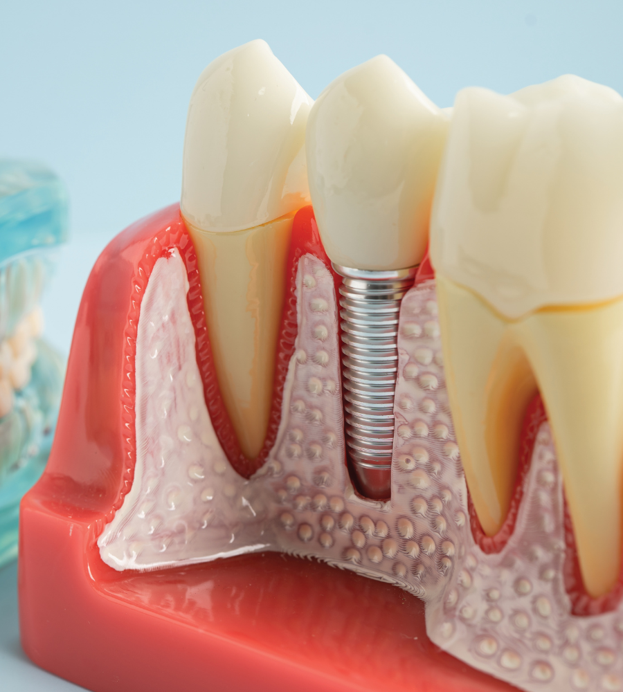 Implant Aftercare Image