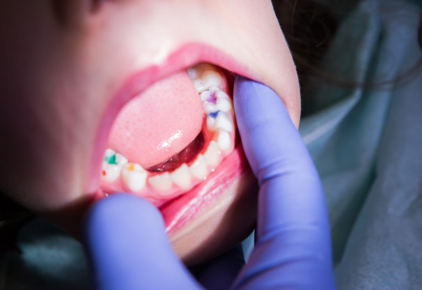 benefits-of-sealants-for-childrens-teeth-2-img